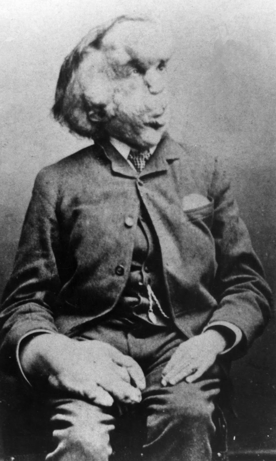 John Merrick