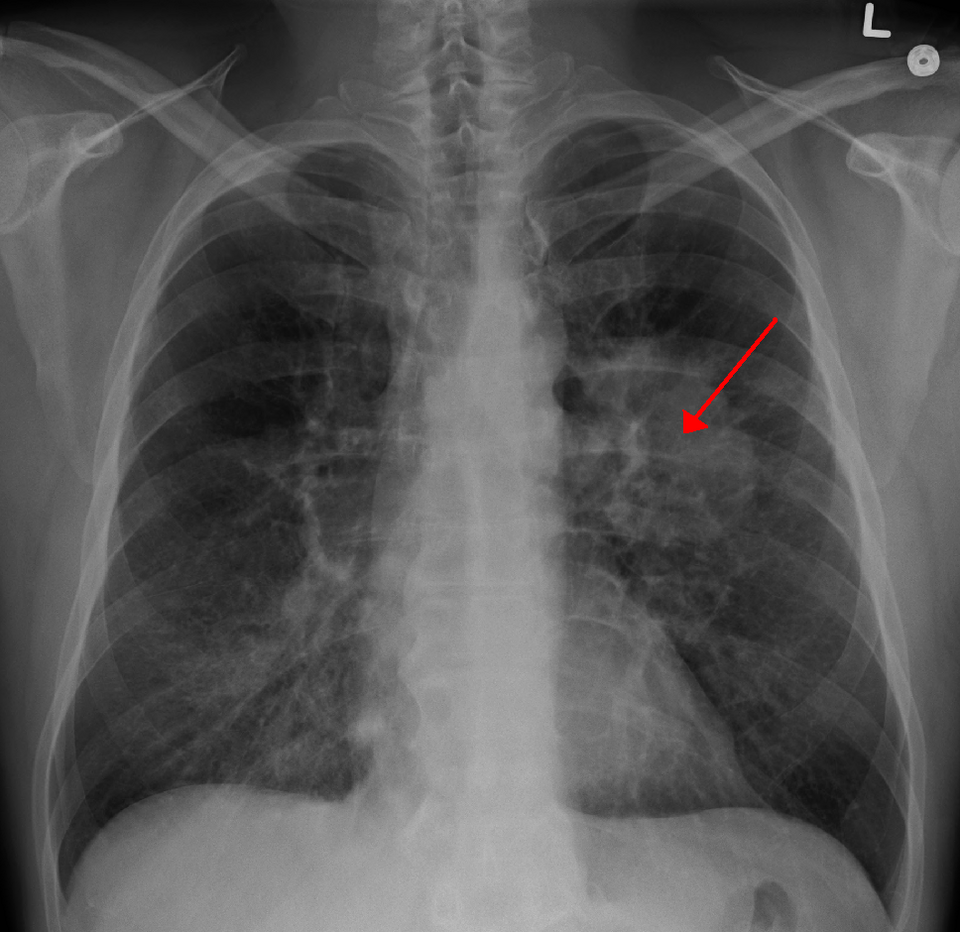 Lung Tor