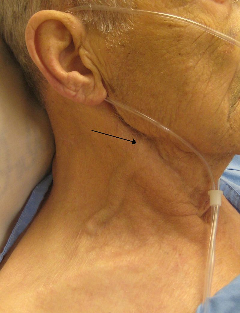 Unknown Heart Failure Patient